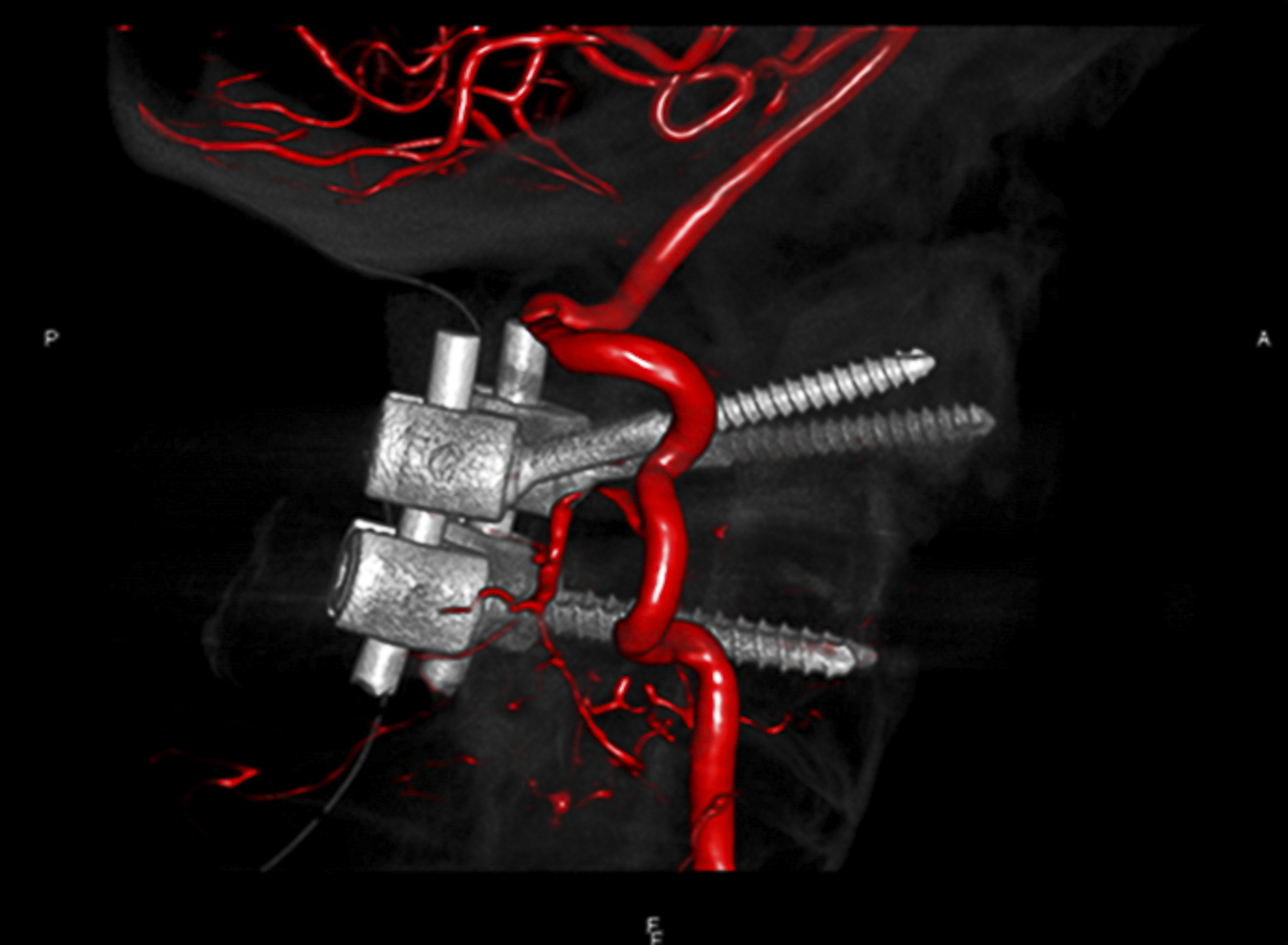 Schrauben an der oberen Halswirbelsäule vorbei an der hinteren Halsschlagader (Computertomographie (CT) 3D-Rekonstruktion, Universitätsklinik für Neurochirurgie, Inselspital Bern)
