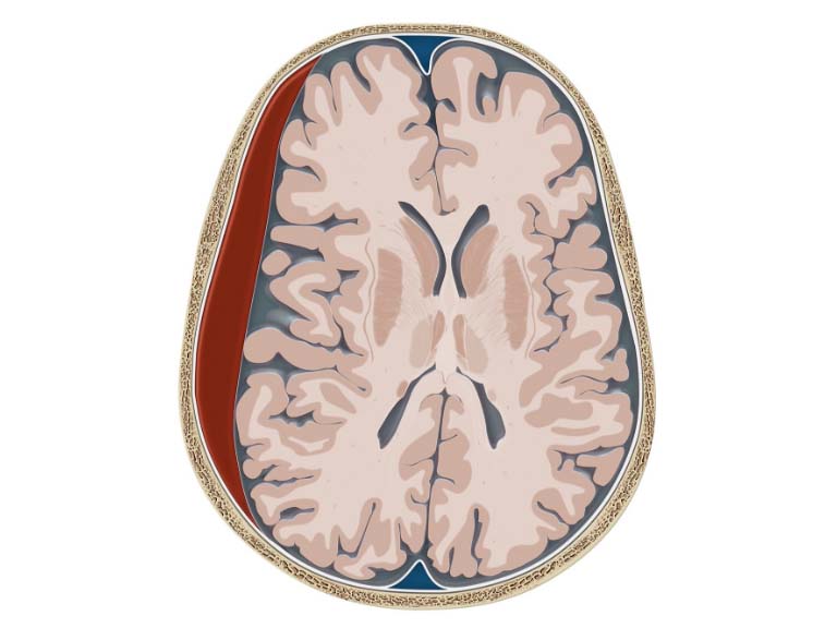 Schematic skull with bleeding