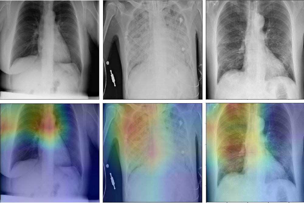 Die Studie vergleicht die neu entwickelte KI- basierte Röntgenbildanalyse mit einer herkömmlichen Beurteilung durch Radiologinnen und Radiologen. Gegenstand sind drei Gruppen von Röntgenbildern: normale Lunge, andere Lungenentzündung, Covid-19- Erkrankung